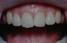 Before Cosmetic Dentistry, Walnut Creek CA
