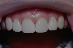 After Cosmetic Dentistry, Walnut Creek CA
