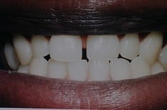 Before Dental Bonding, Walnut Creek CA