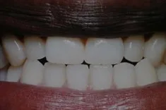 After Dental Bonding, Walnut Creek CA
