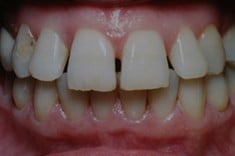 Before Porcelain Veneers, Walnut Creek CA