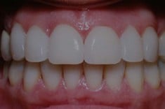 After Porcelain Veneers, Walnut Creek CA