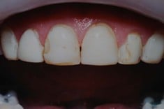 Before Porcelain Veneers, Walnut Creek CA