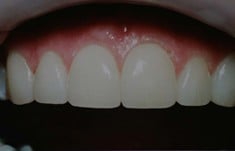 After Porcelain Veneers, Walnut Creek CA