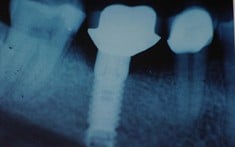 Xray of Titanium Dental Implants, Walnut Creek CA