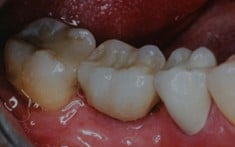 Dental Implants, Walnut Creek CA