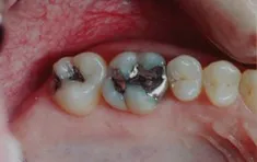 Before - with Silver Fillings, Walnut Creek CA