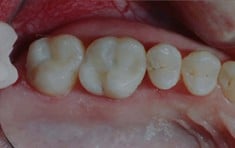 After - with Tooth-Colored Composite, Walnut Creek CA