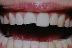 Before Dental Bonding, Walnut Creek CA