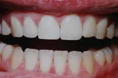 After Dental Bonding, Walnut Creek CA