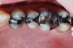 Before - with Silver Fillings, Walnut Creek CA