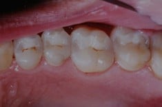 After - with Tooth-Colored Composite, Walnut Creek CA